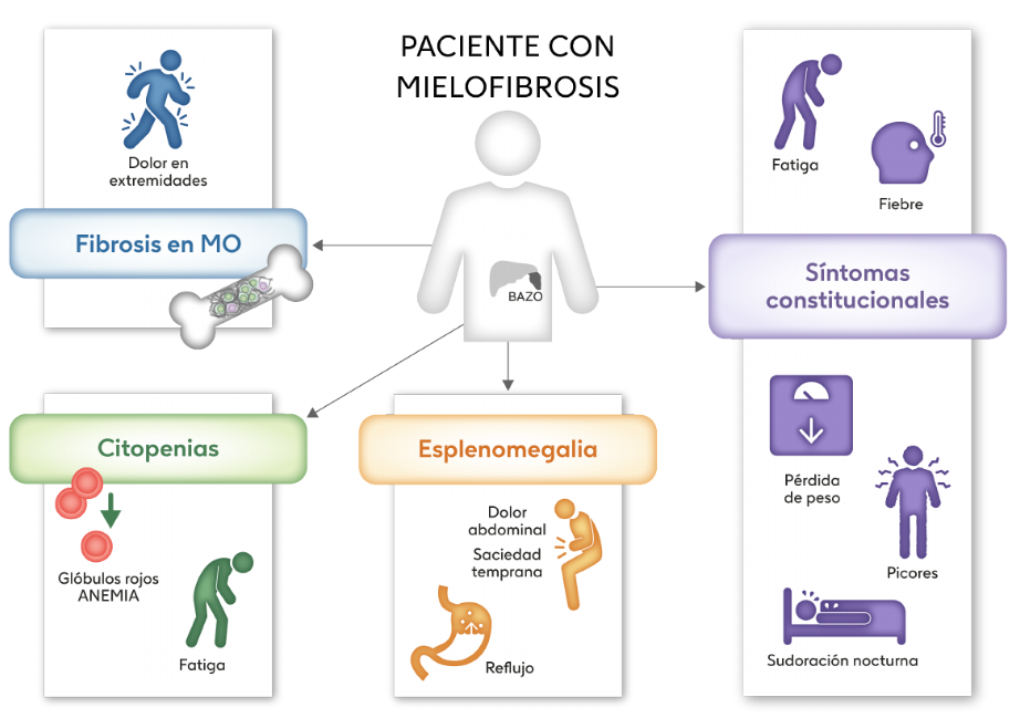 Sintomas mielofibrosis, hematies bajos, fatiga muscular