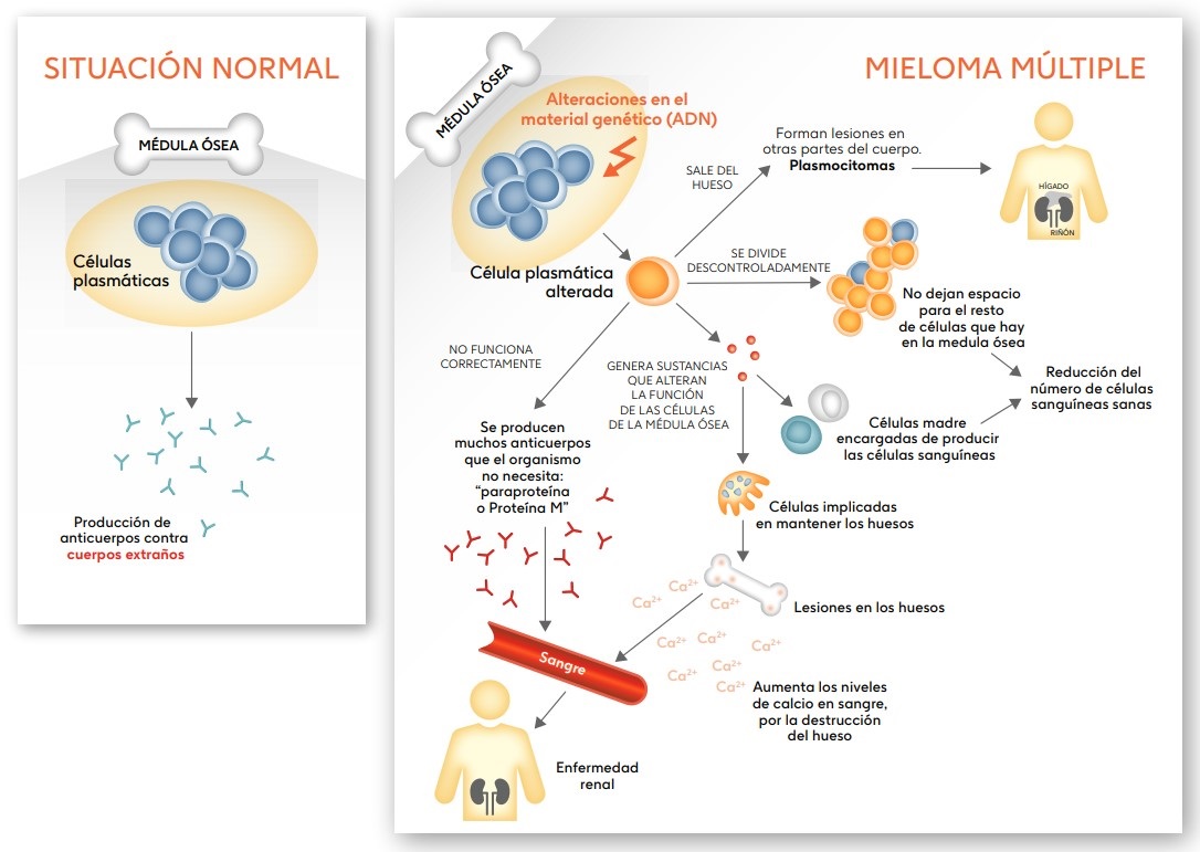 Infografía de qué es el mieloma múltiple