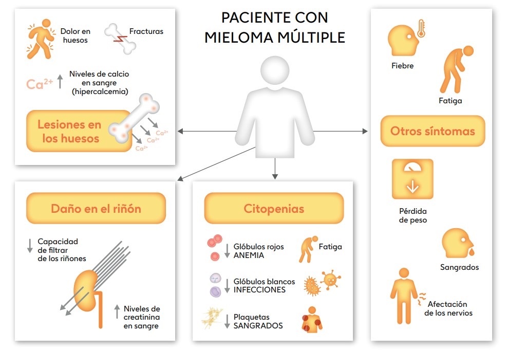 Infografía de los síntomas del mieloma múltiple